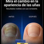 Parches Antihongos para Uñas – Mejora La Salud de tus Uñas Mientras Duermes en 7 días– Tratamiento Fácil, Limpio y Efectivo
